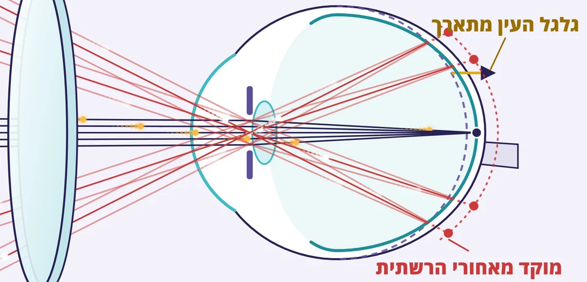עדשה רגילה: קרני השוליים מתמקדות מאחורי הרשתית, וגלגל העין מתארך. שרטוט מתוך סרטון ההסבר של אופטיטופ