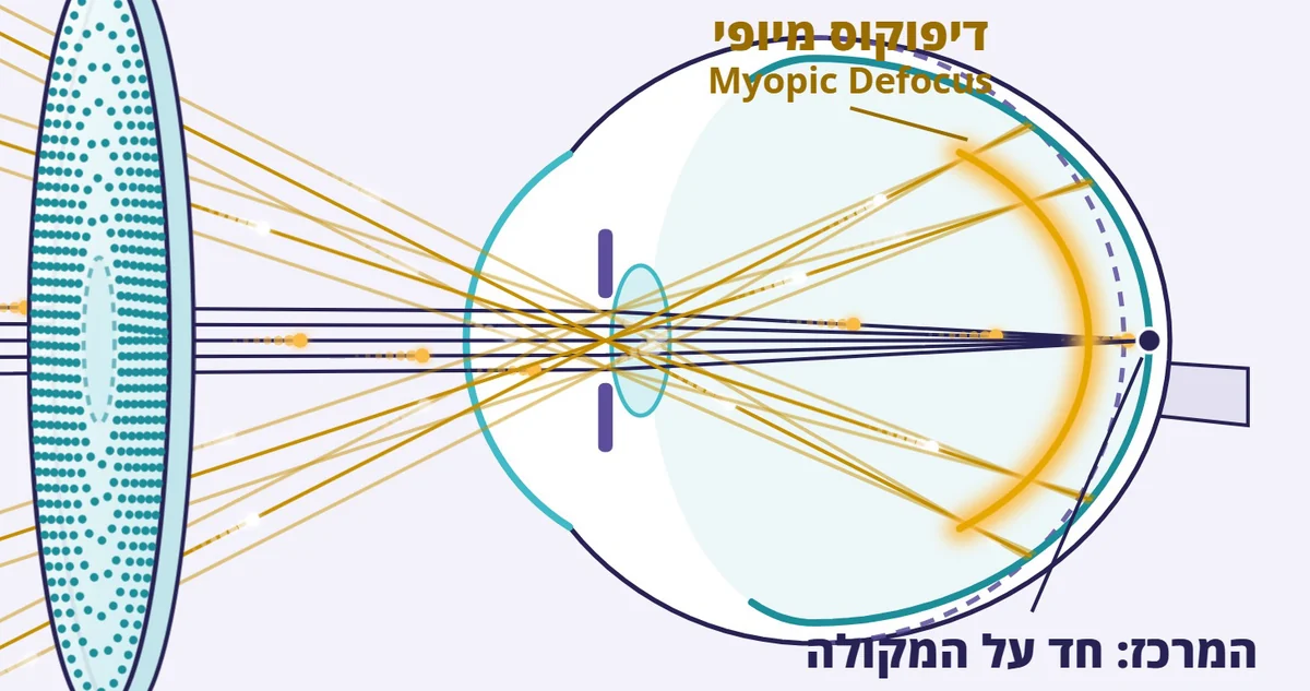 עדשת מיופיה קונטרול עם דיפוקוס: דרך המרכז חד על המקולה, ודרך הטבעות מוקד לפני הרשתית. שרטוט מתוך סרטון ההסבר של אופטיטופ, חיפה